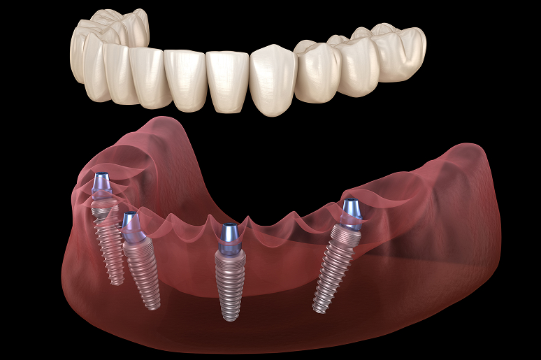 All-on-4 full arch implant procedure