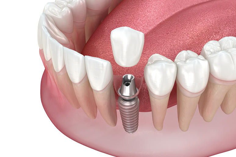 Single implant procedure illustration